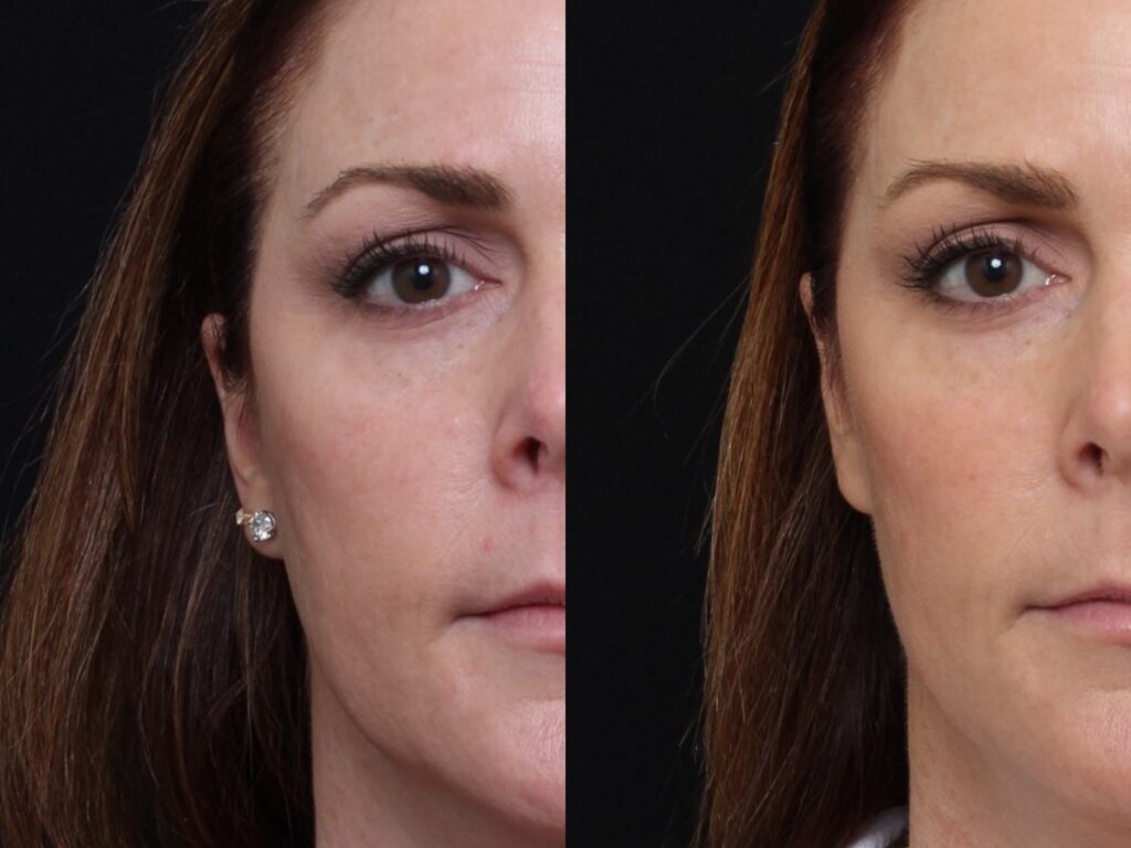 KB LIFT Results & ©Brian S. Biesman, M.D