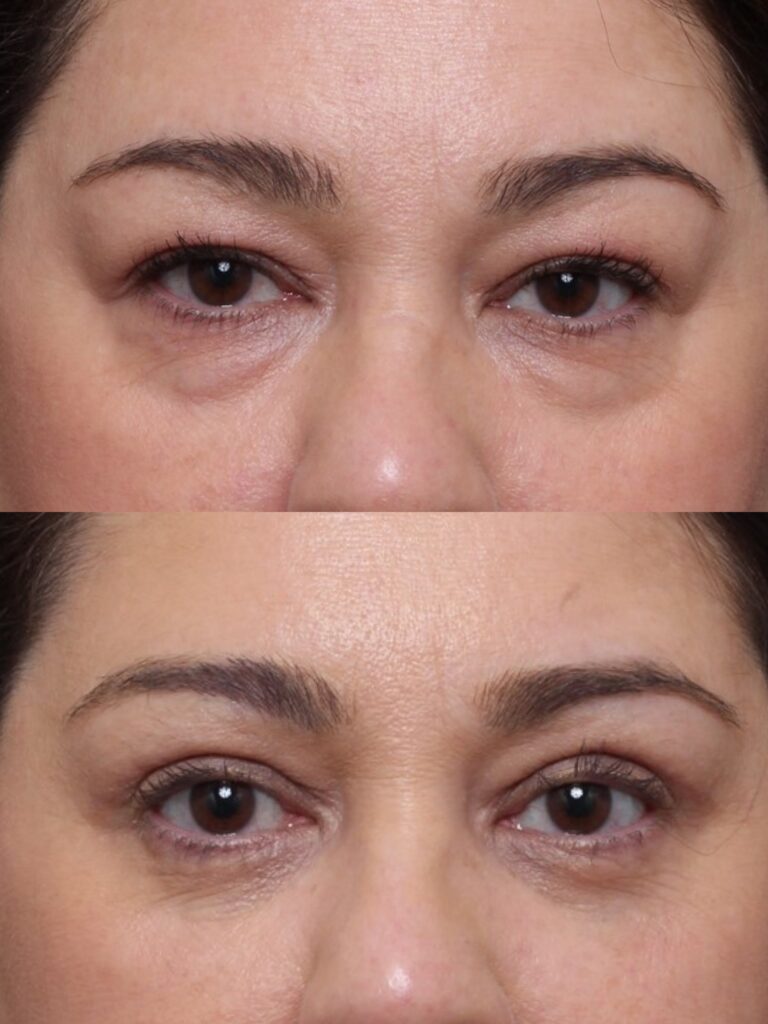 Bilateral Upper and Lower Lid Blepharoplasty Results & ©Brian S. Biesman, M.D. Nashville
