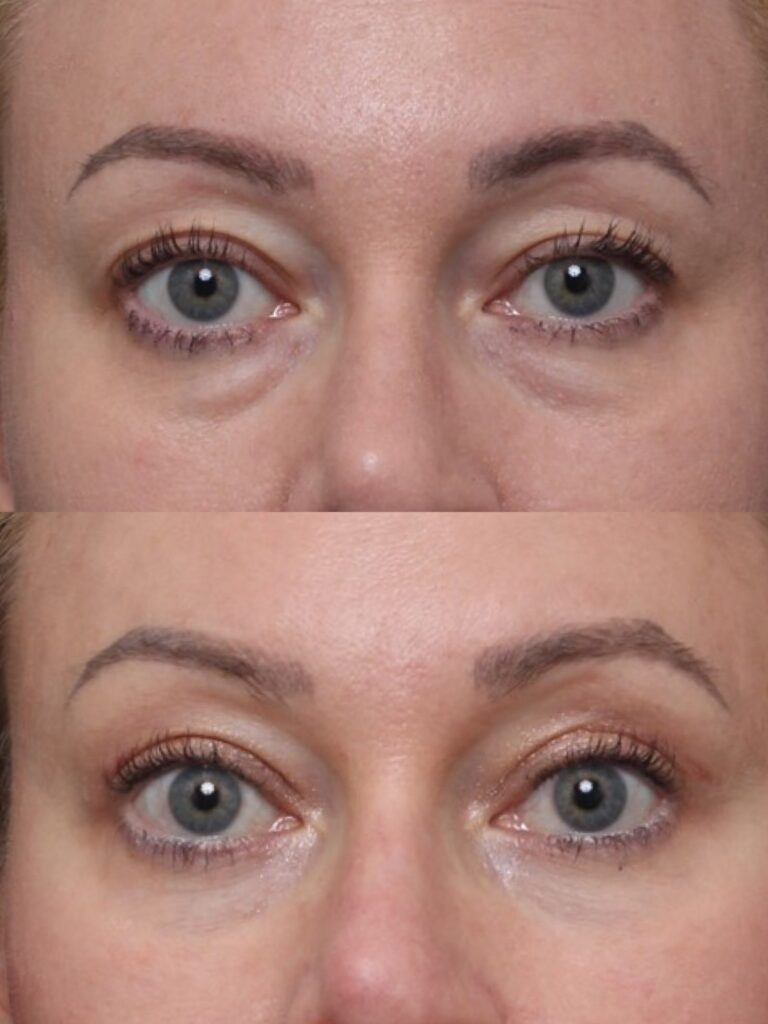 Bilateral Upper & Lower Lid Blepharoplasty & Fasanella Ptosis Repair Results