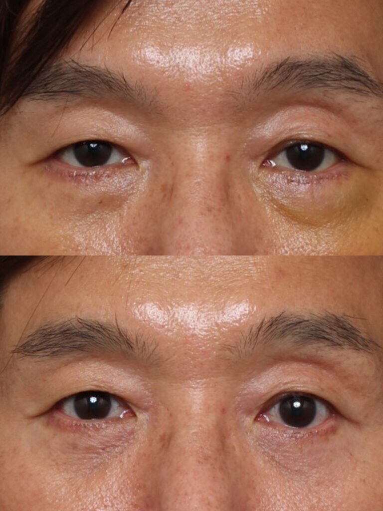 Bilateral Lower Lid Blepharoplasty Results Nashville