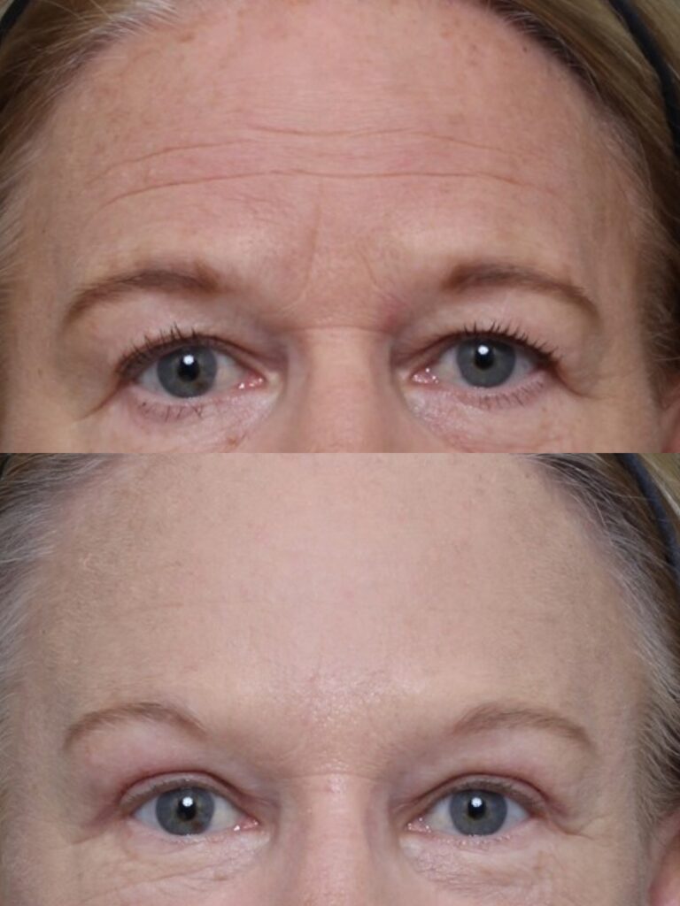 Bilateral Upper Lid Blepharoplasty & Endoscopic Brow Lifting