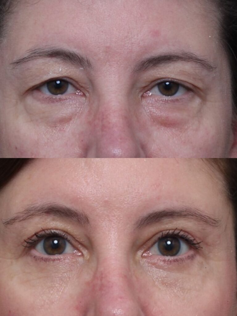 Bilateral Upper & Lower Lid Blepharoplasty & Ptosis Repair 2