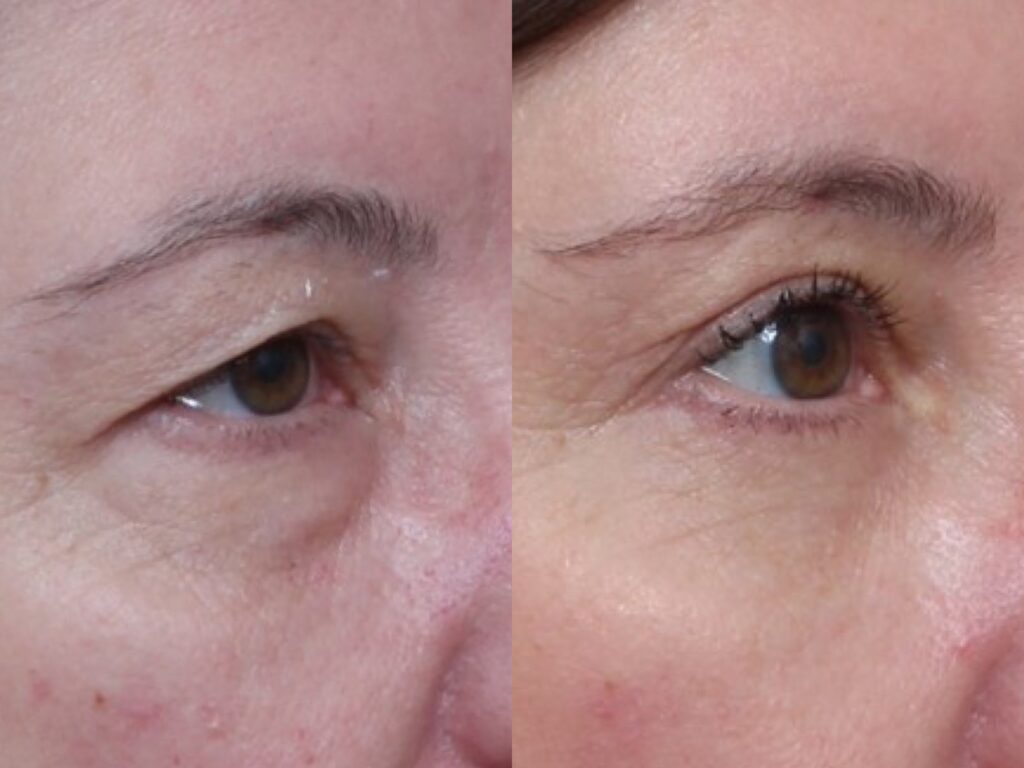 Bilateral Upper & Lower Lid Blepharoplasty & Ptosis Repair