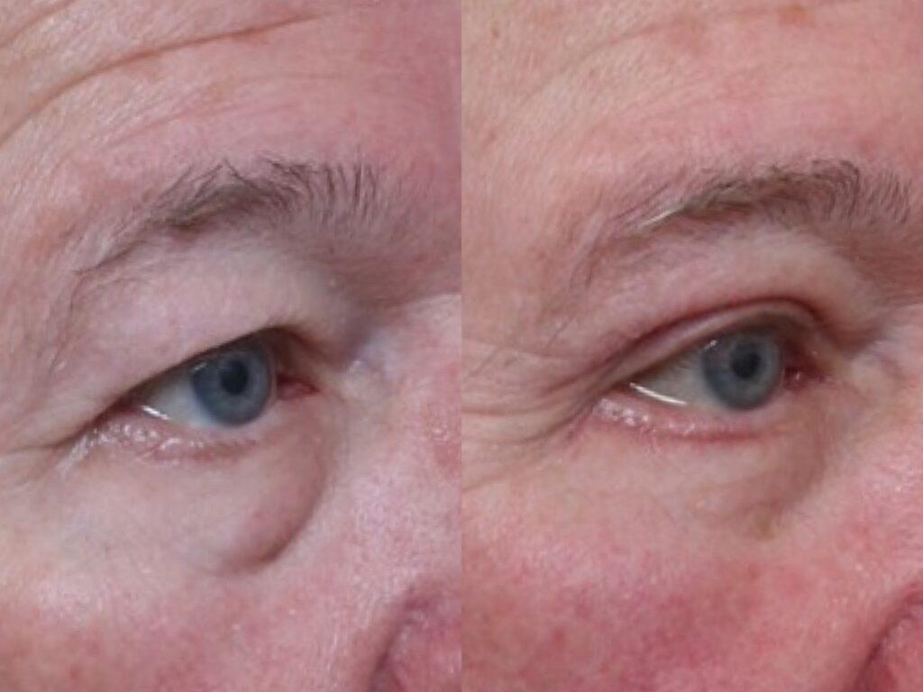 Bilateral Upper & Lower Lid Blepharoplasty 6