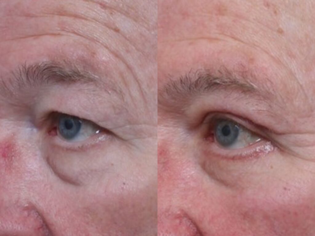 Bilateral Upper and Lower Lid Blepharoplasty & Brow Pexy Nashville