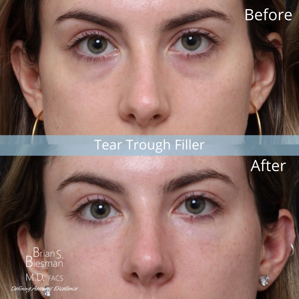 Bilateral Tear Trough Fillers Results 2