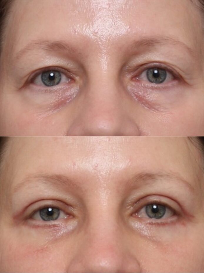 Bilateral Upper and Lower Lid Blepharoplasty
