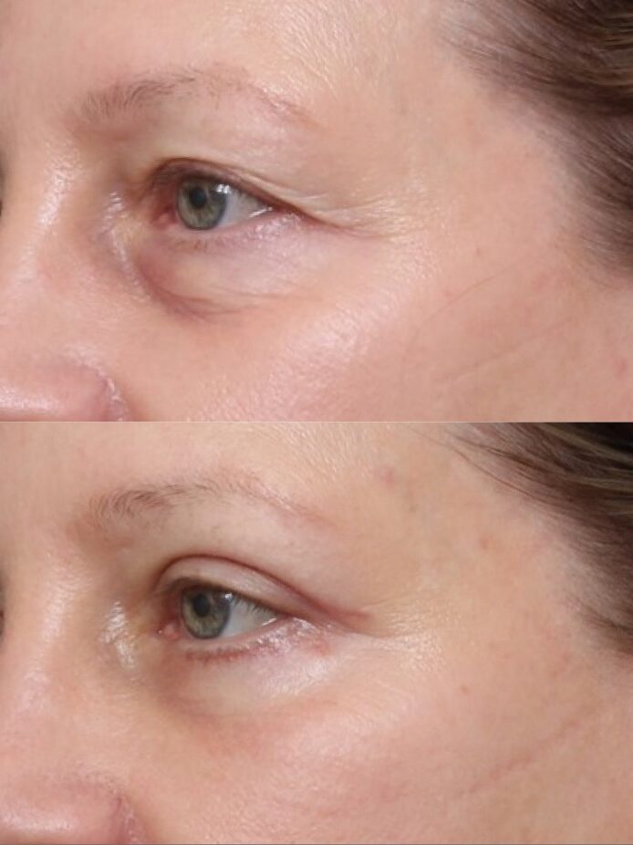 Bilateral Upper & Lower Lid Blepharoplasty 34