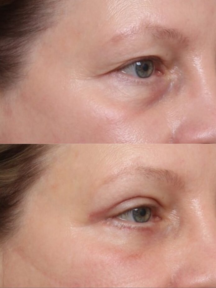 Bilateral Upper & Lower Lid Blepharoplasty 2