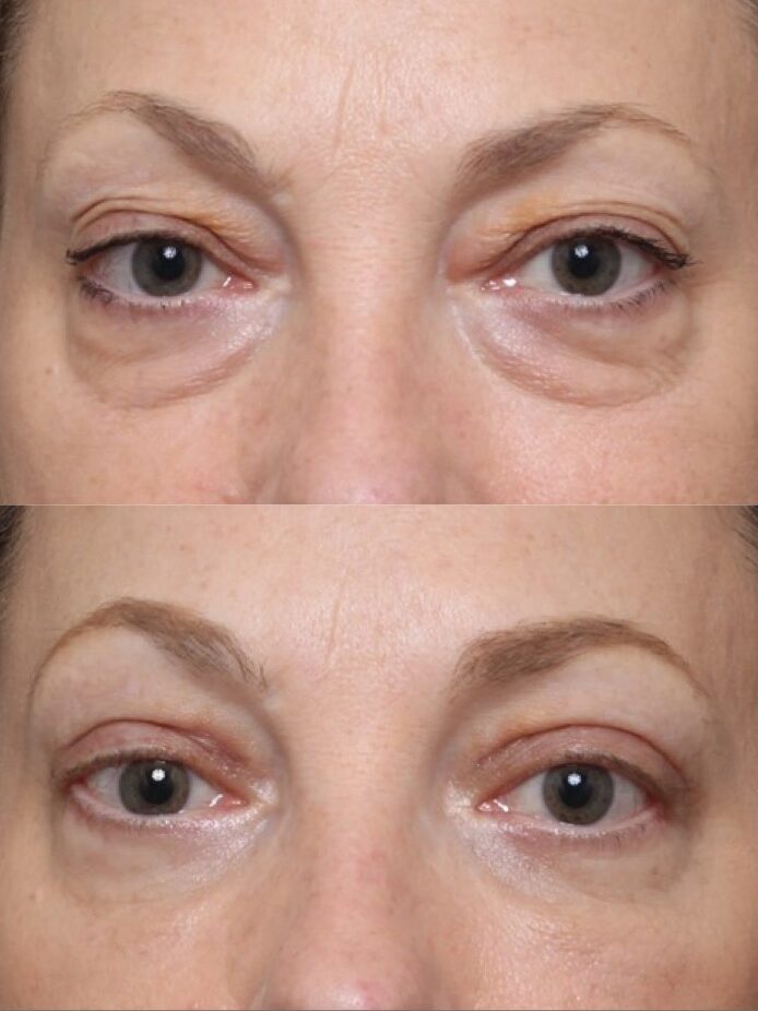 Bilateral Upper Lid Blepharoplasty 5