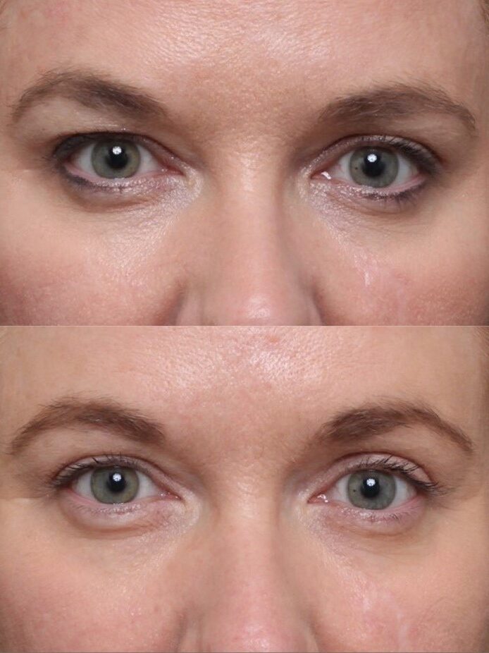 Bilateral Upper Lid Blepharoplasty & Brow Pexy - Results & ©Brian S. Biesman, M.D.