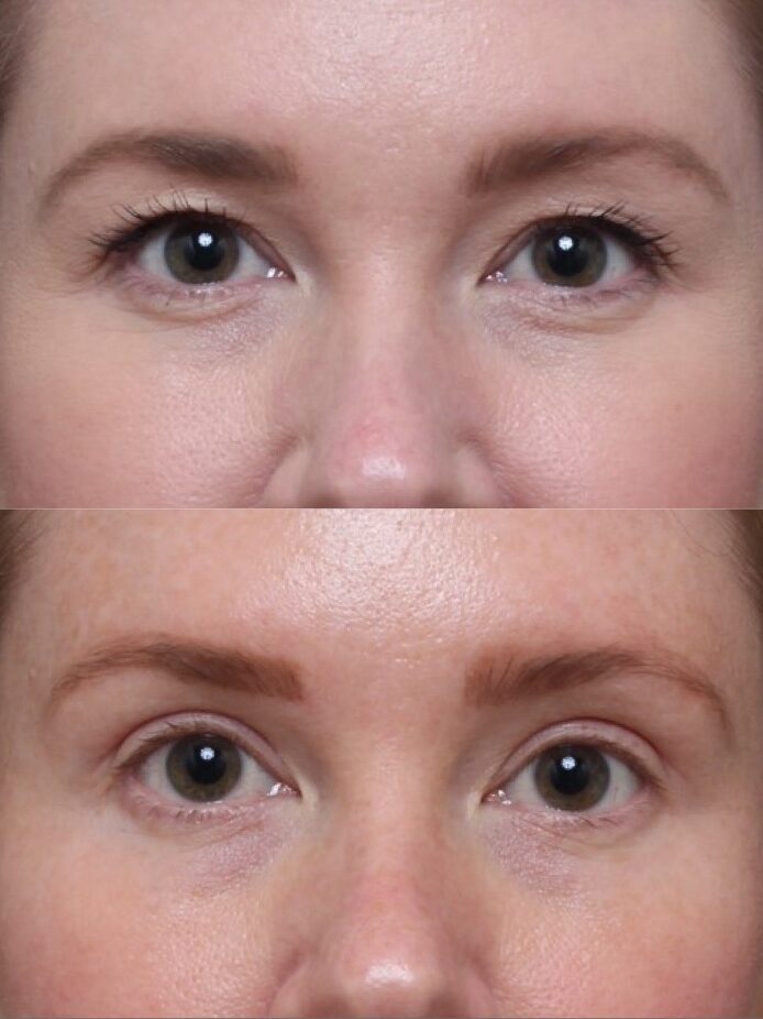 Bilateral Upper Lid Blepharoplasty 4