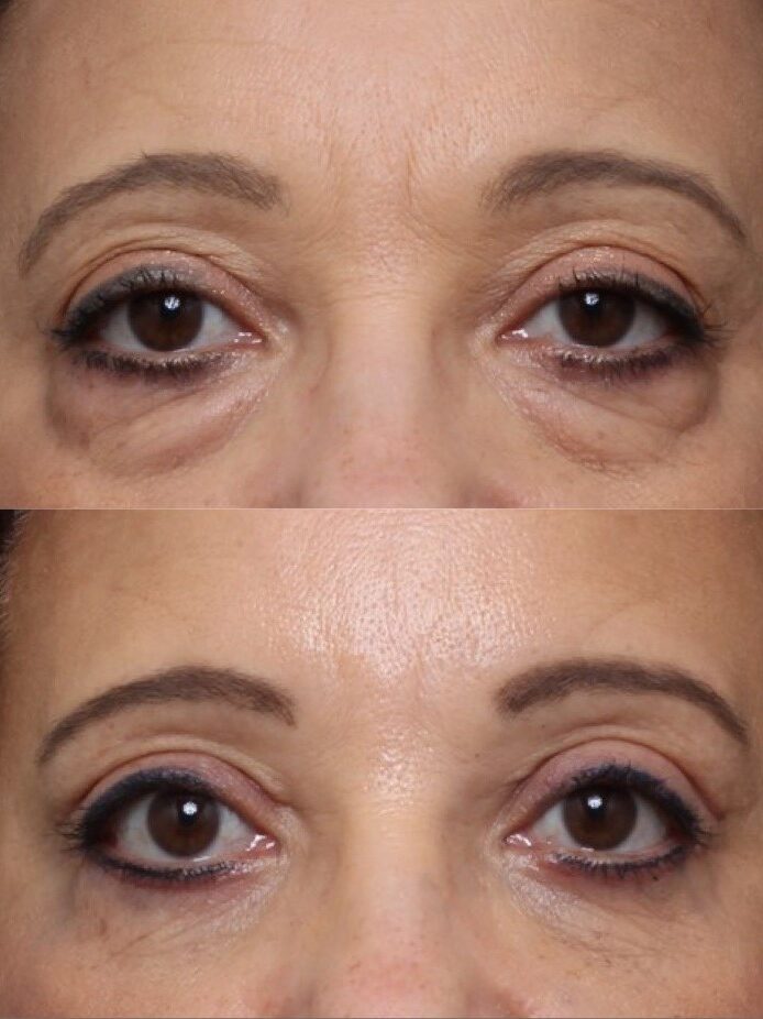 Bilateral Upper & Lower Lid Blepharoplasty