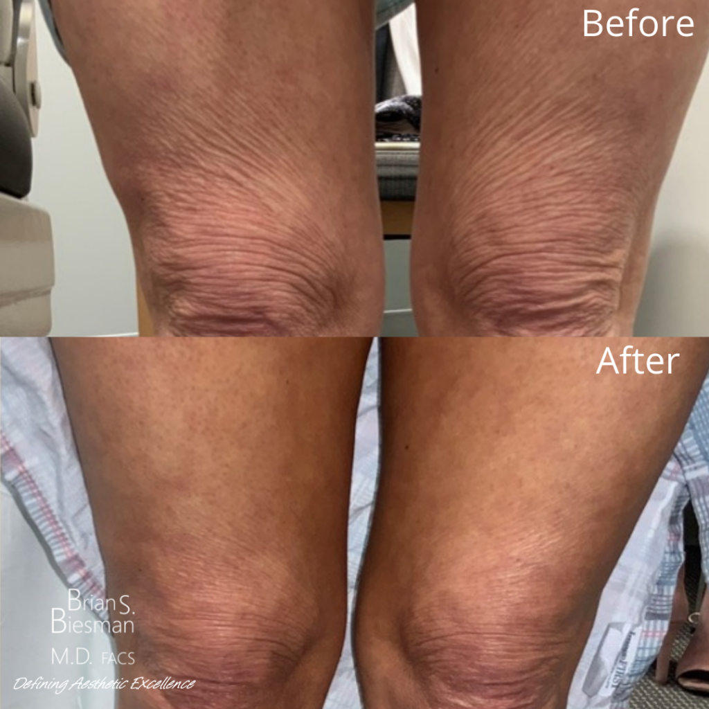 Dilute Radiesse in the knees - Results & ©Brian S. Biesman, M.D.