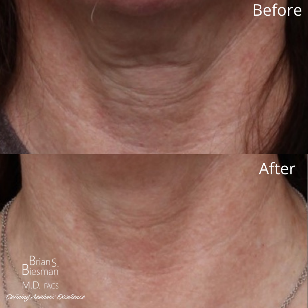 Dilute Radiesse bEFORE AND AFTER