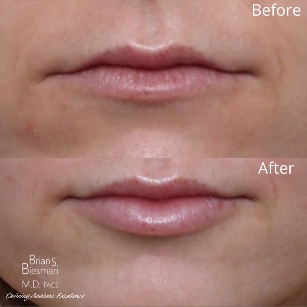 Lip injections - Results & ©Brian S. Biesman, M.D.
