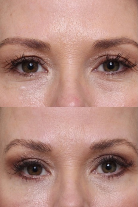 Bilateral Upper & Lower Lid Blepharoplasty 5