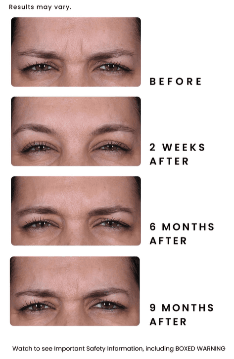 Daxxify pre treatment to 9 months post