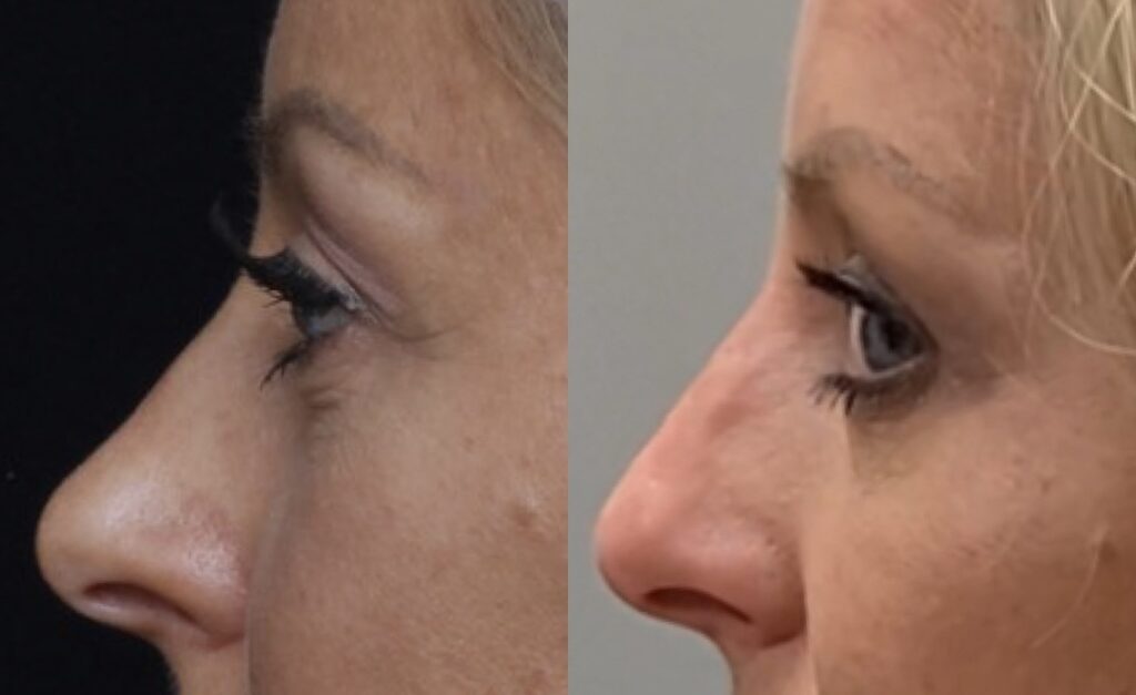Liquid Rhinoplasty -Results & ©Brian S. Biesman, M.D.