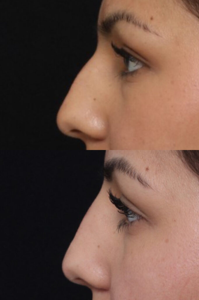 Liquid Rhinoplasty