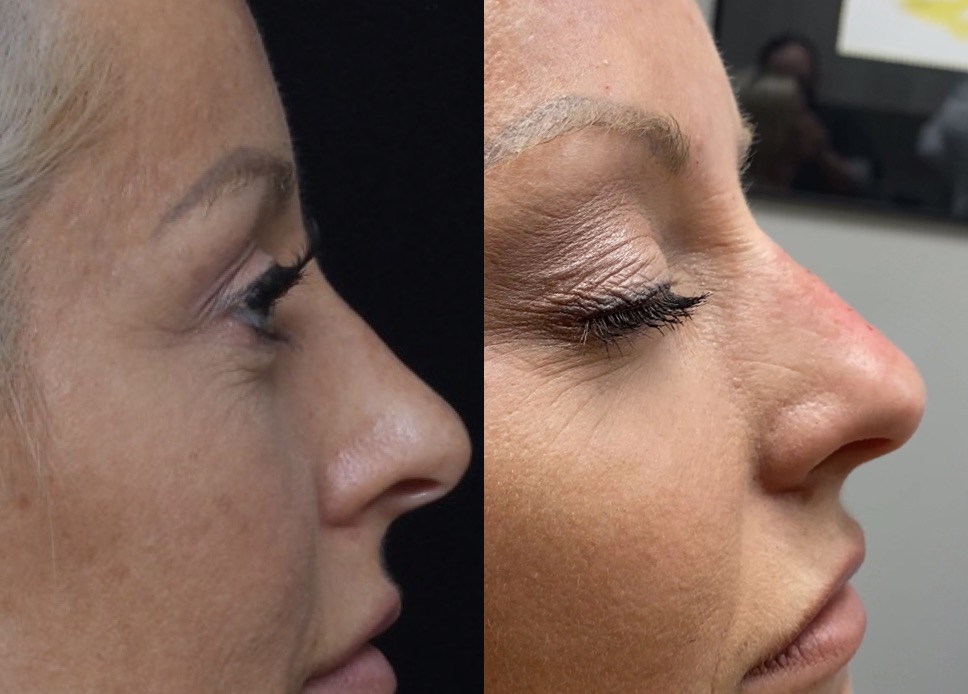 Liquid Rhinoplasty