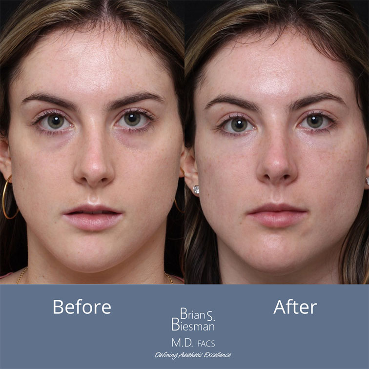 Tear Trough Treatment Nashville
