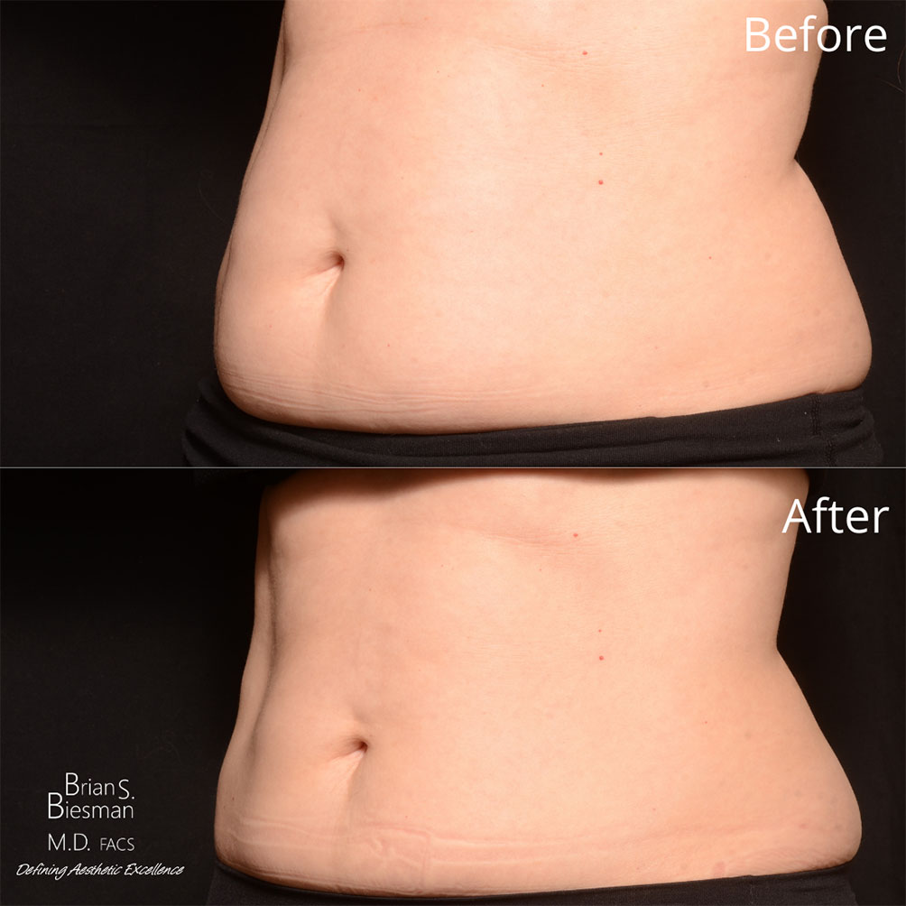 Scar Treatment Nashville