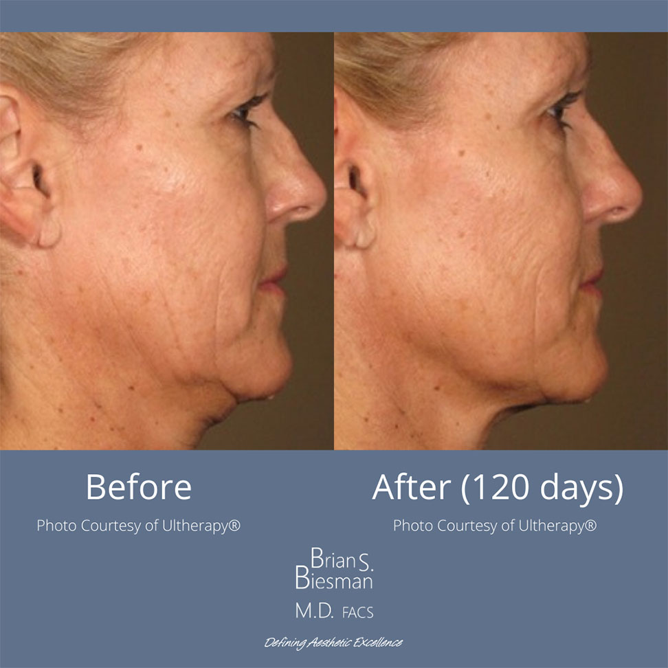 Ultherapy Nashville