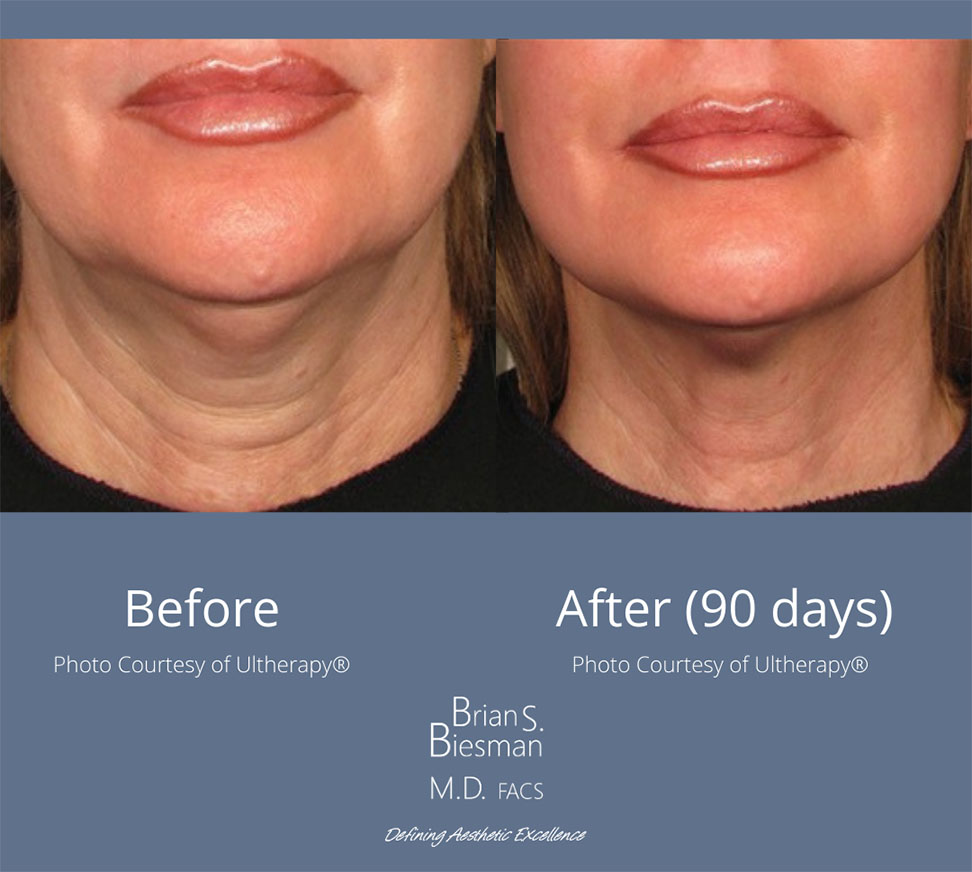 Ultherapy treatment Nashville
