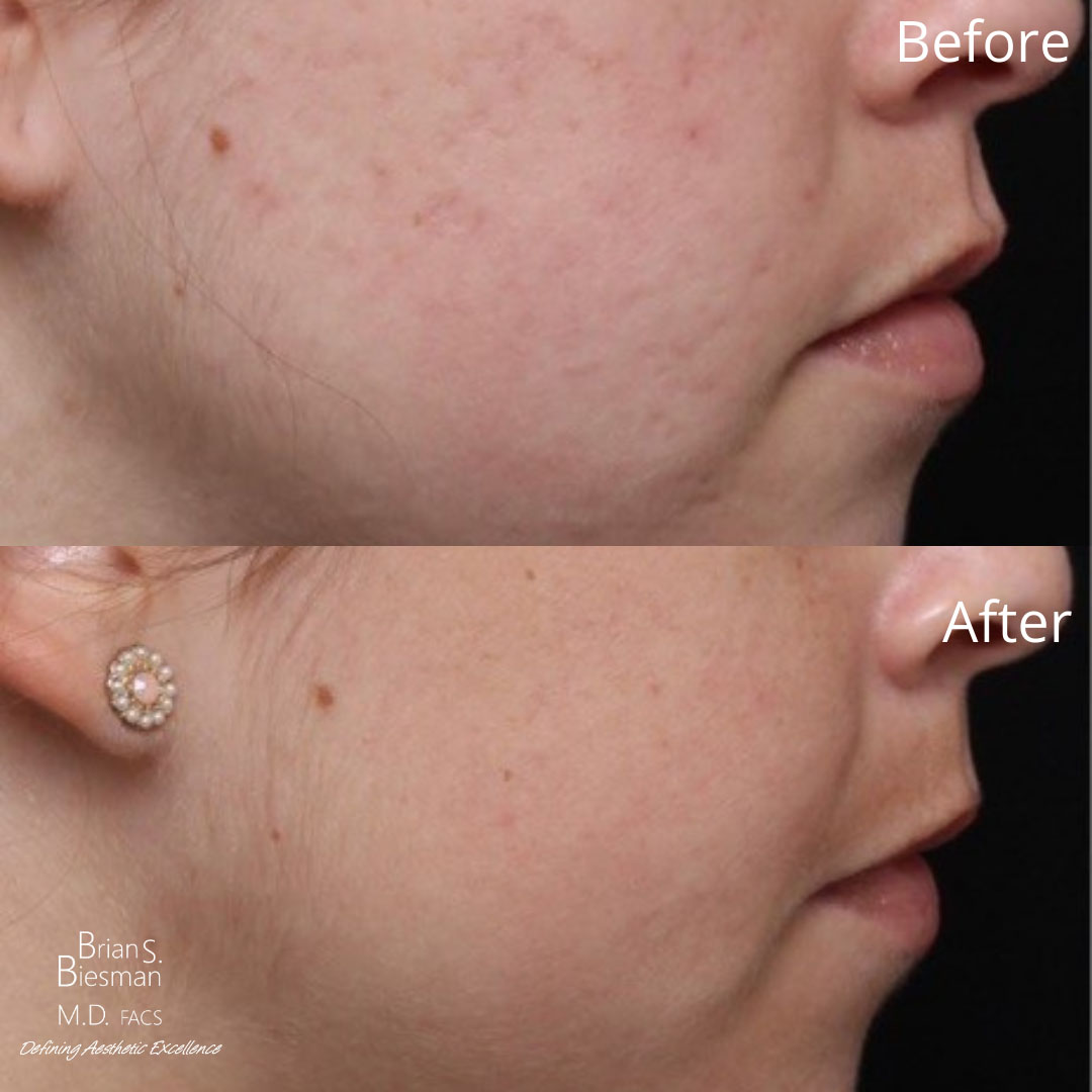 Acne Scar Treatment Before and After Nashville, TN