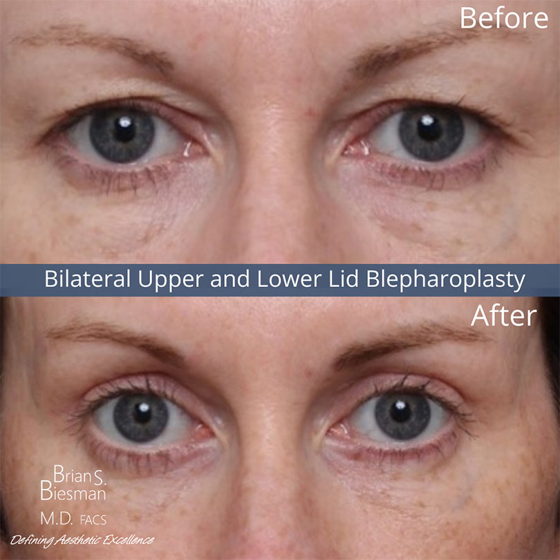 Upper and Lower Lid Belpharoplasty Before and After Photo