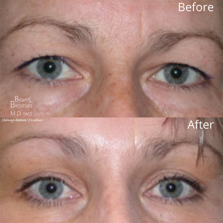 Eyebrow Lift Nashville