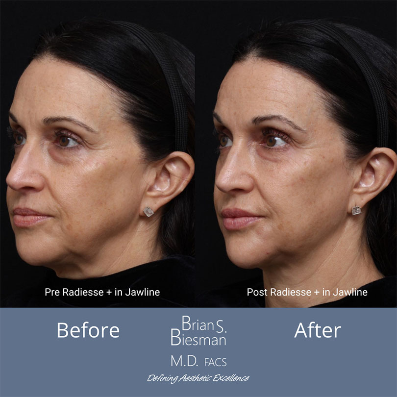 Jawline Augmentation Nashville
