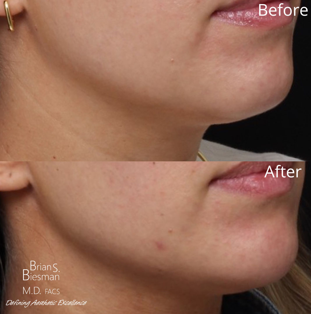 Kybella Before and After