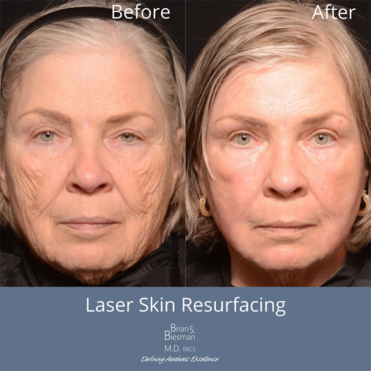 Laser Skin Resurfacing Before and After Photo Nashville, TN