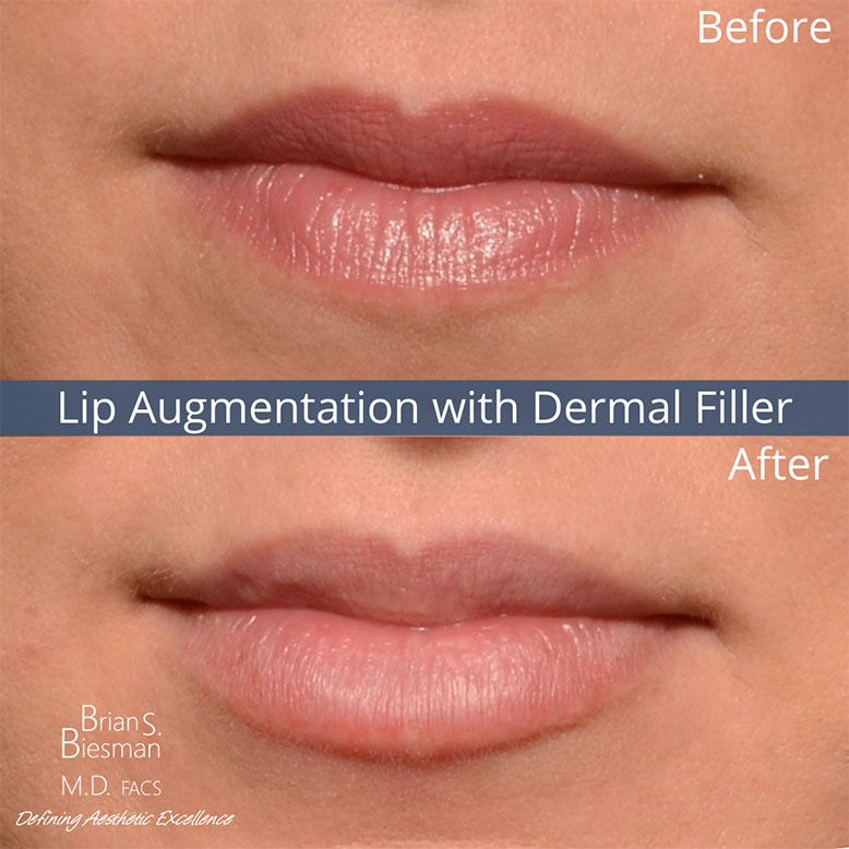 Lip Filler Nashville