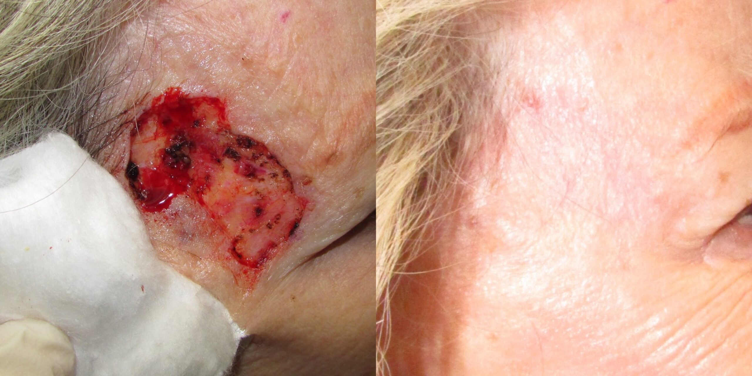 Repair of Mohs Micrographic Surgery