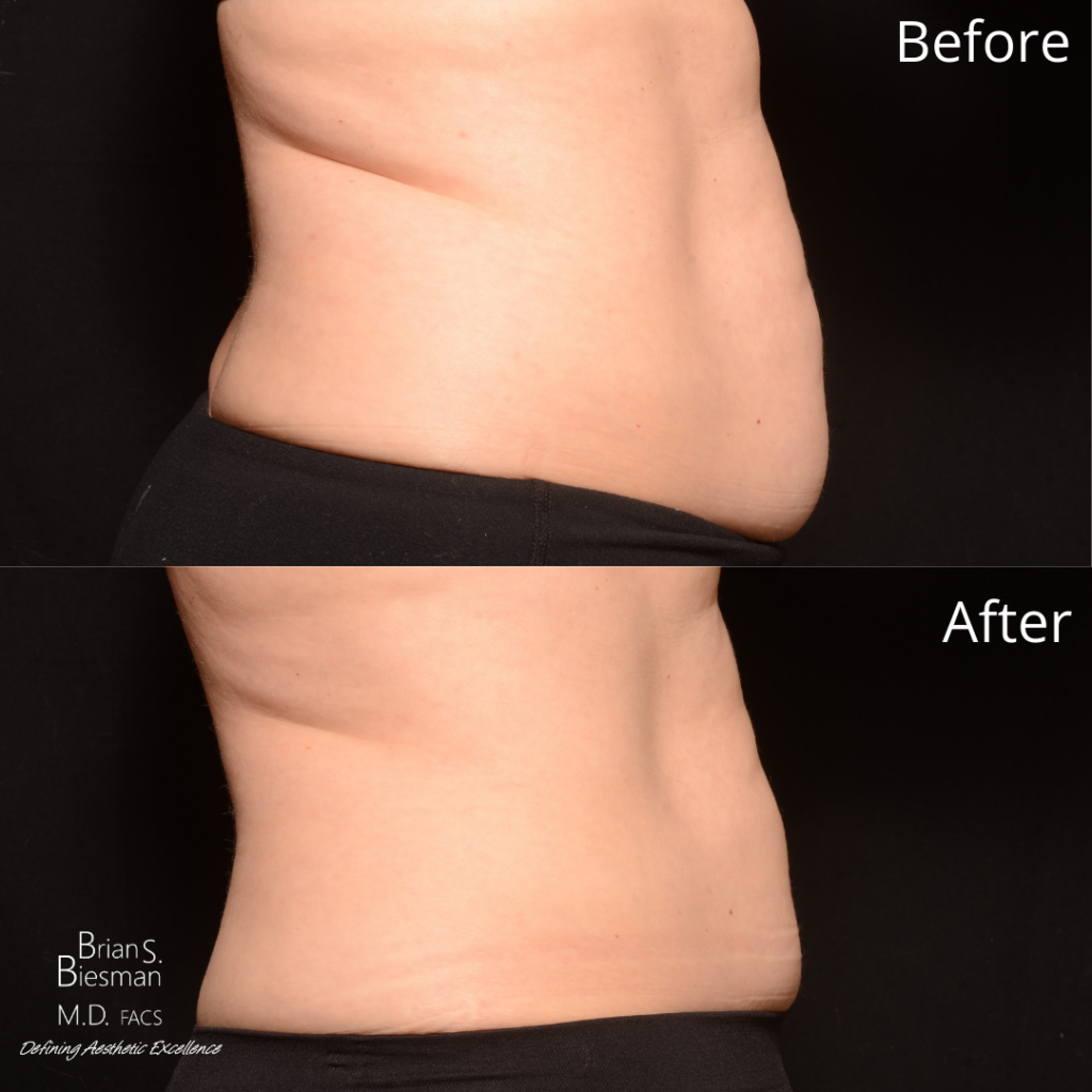 CoolSculpting Non - Invasive Fat Reduction