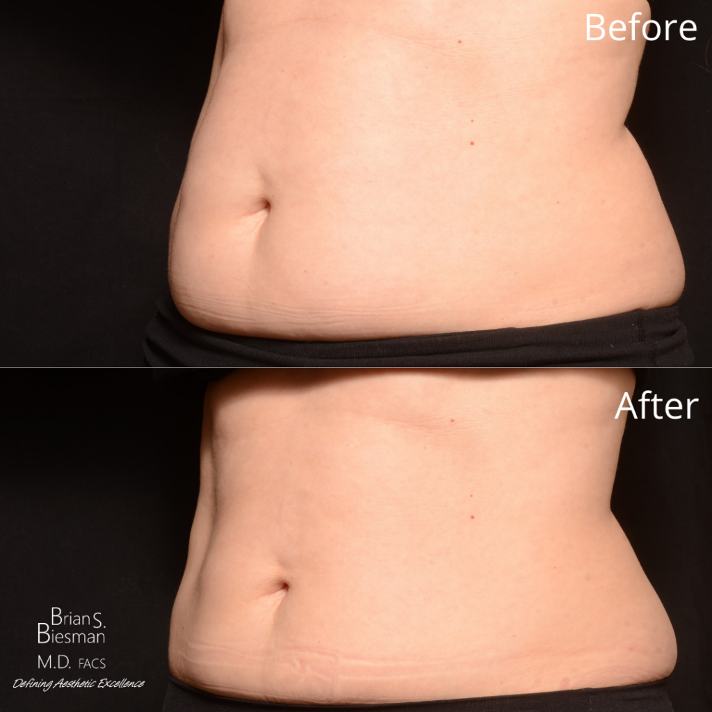 CoolSculpting Non- Invasive Fat Reduction
