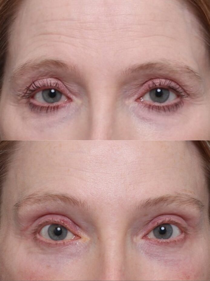 Nashville Eyelid Surgery In Nashville