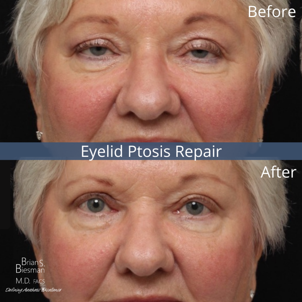 Bilateral Upper Lid Ptosis Repair Nashville