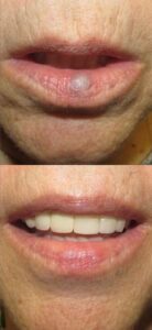 Venuous lake lip treatment