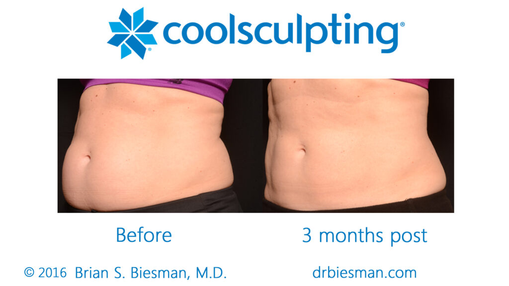 Cool Sculpting