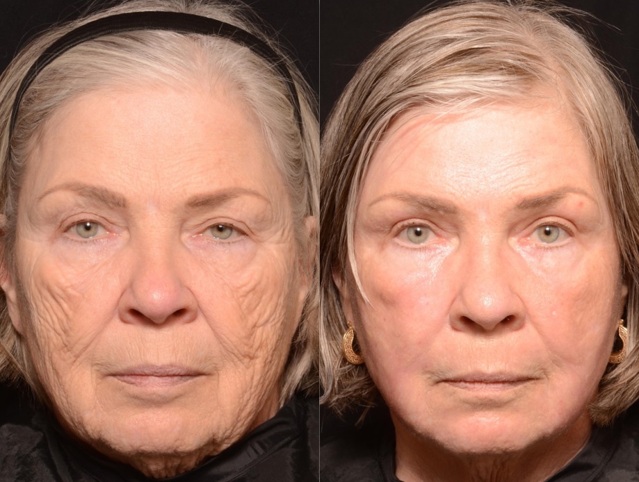 Results & © Brian S. Biesman, M.D.