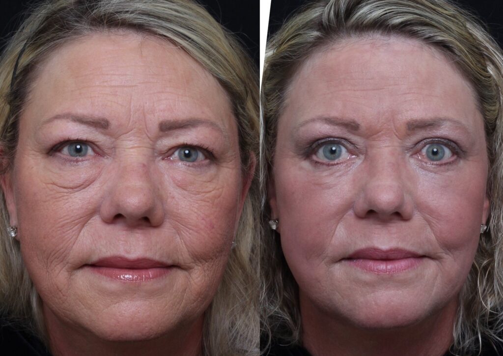 Full Face Treatment