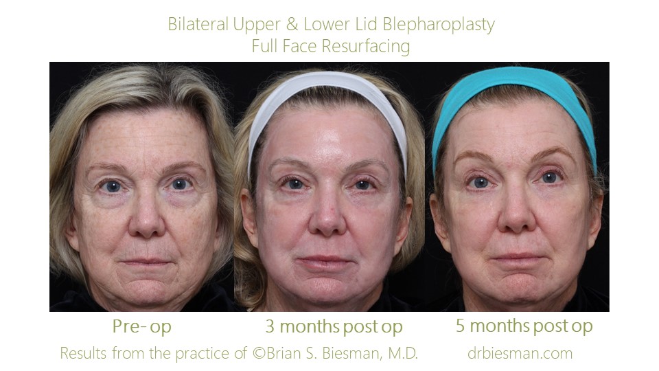 Full Face Treatment Nashville