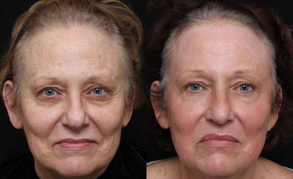 Full Face Full Ablative Fractional Laser Skin Resurfacing Treatment