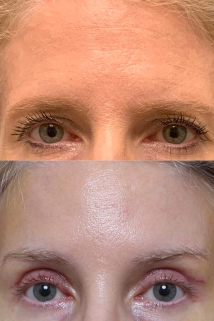 Endoscopic Brow Lifting, Bilateral Upper lid Blepharoplasty