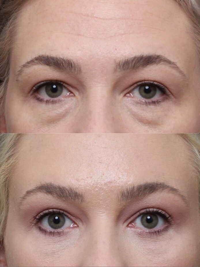 Bilateral Upper and lower lid Blepharoplasty