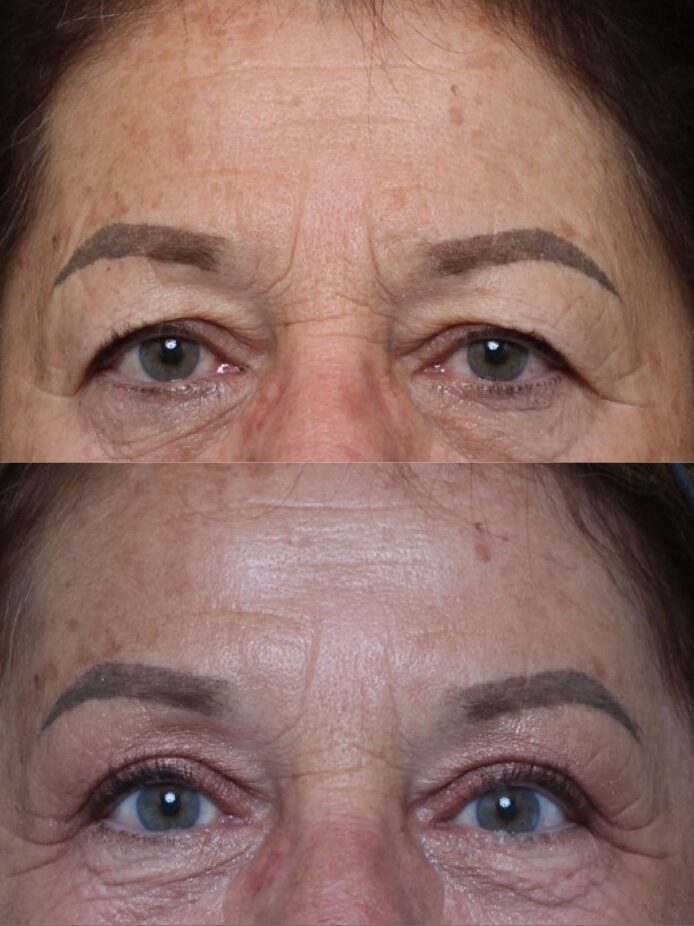 Nashville Eyelid Surgery